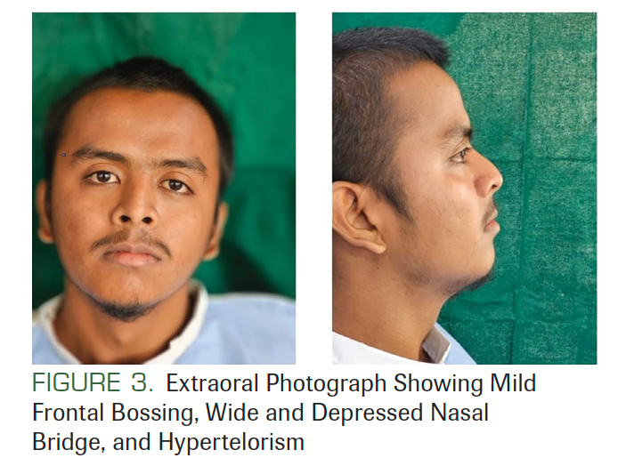 FIGURE 3. Extraoral Photograph Showing Mild Frontal Bossing, Wide and Depressed Nasal Bridge, and Hypertelorism