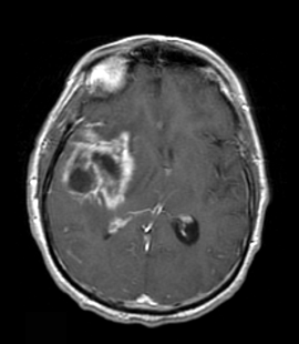 MRI showing brain tumor.