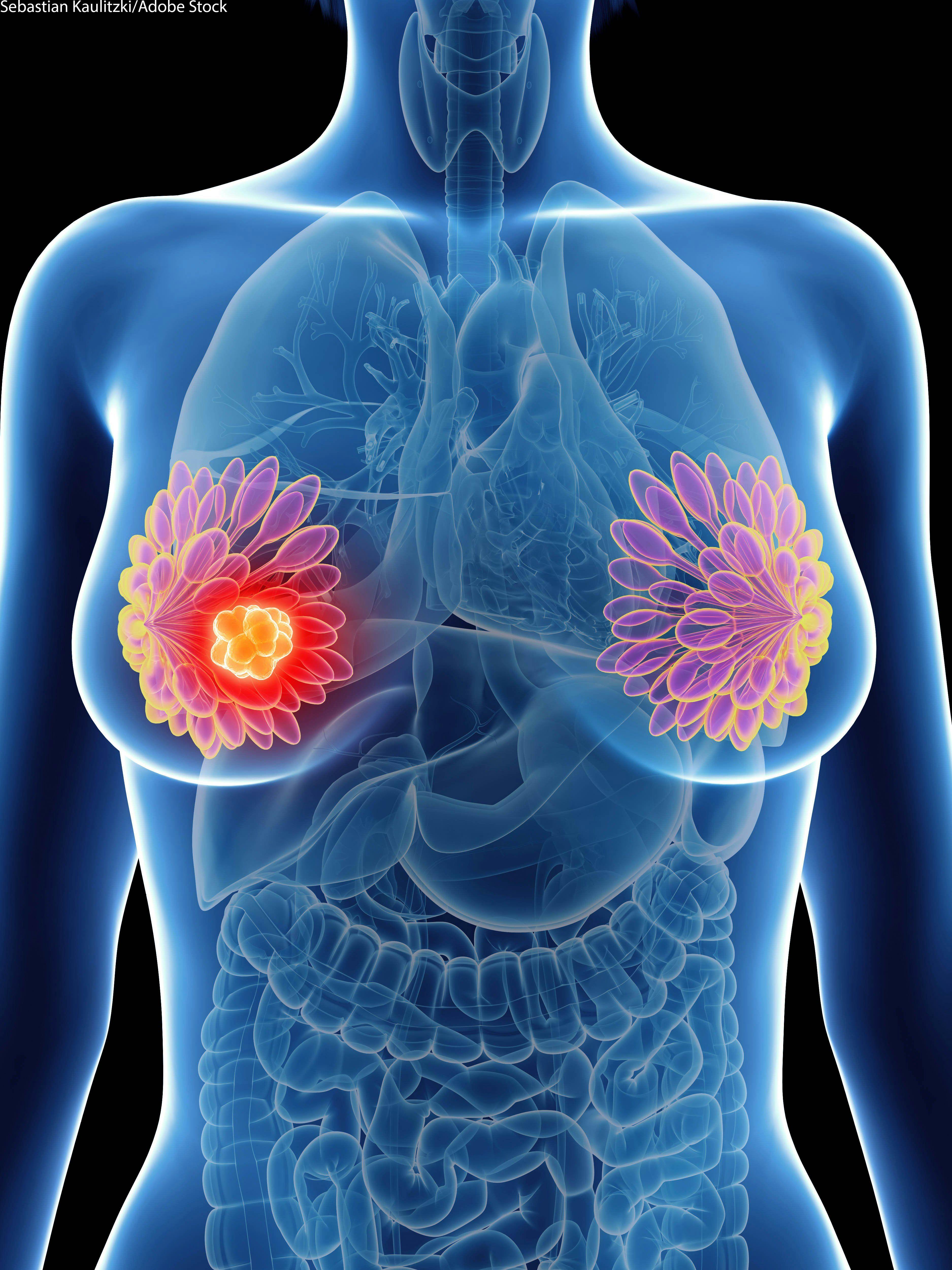 Addition of Abemaciclib to Fulvestrant Improves OS in HR+, HER2- Advanced Breast Cancer