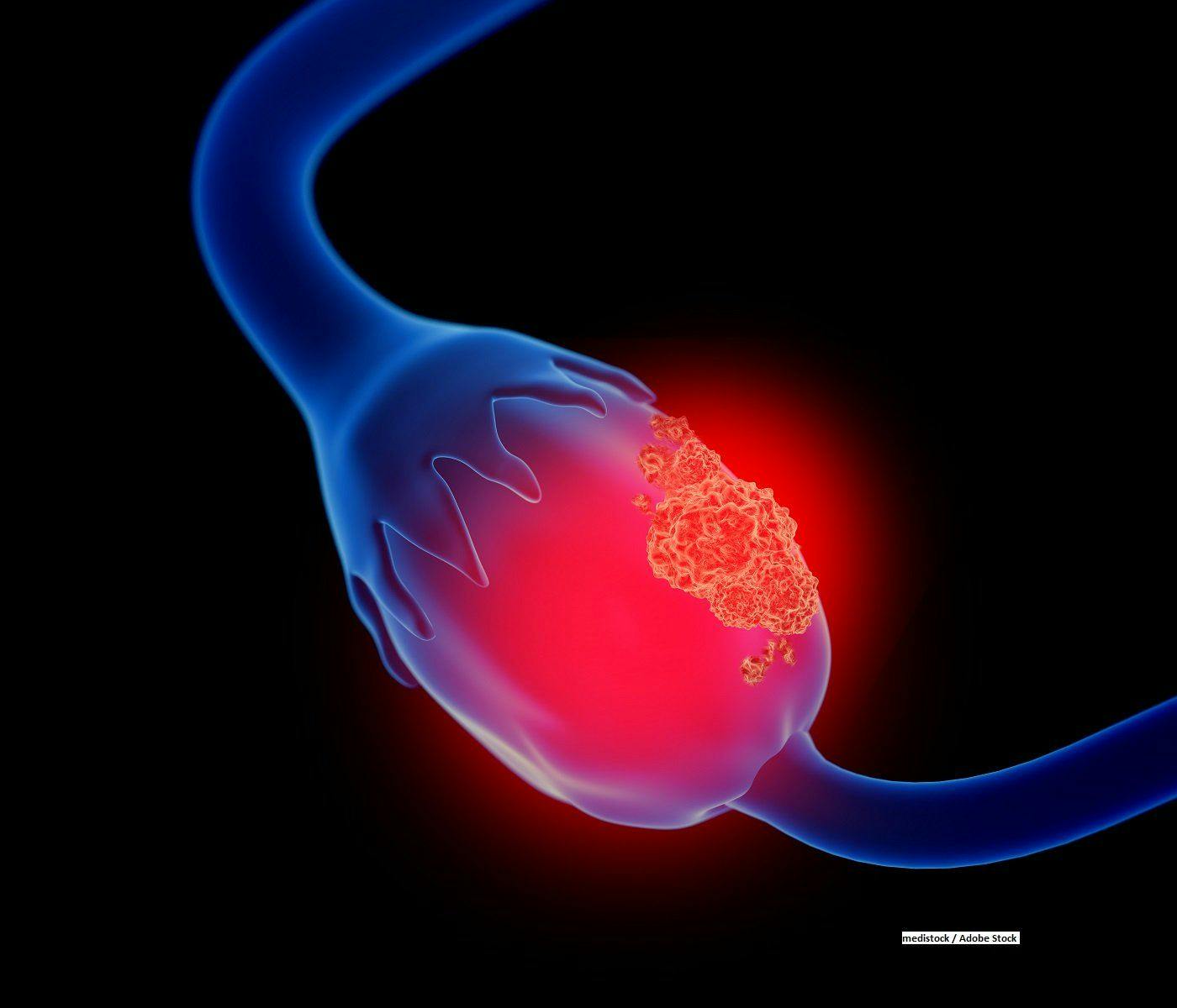 Oncogene S100A10 May Play Role in Progression of Ovarian Cancer