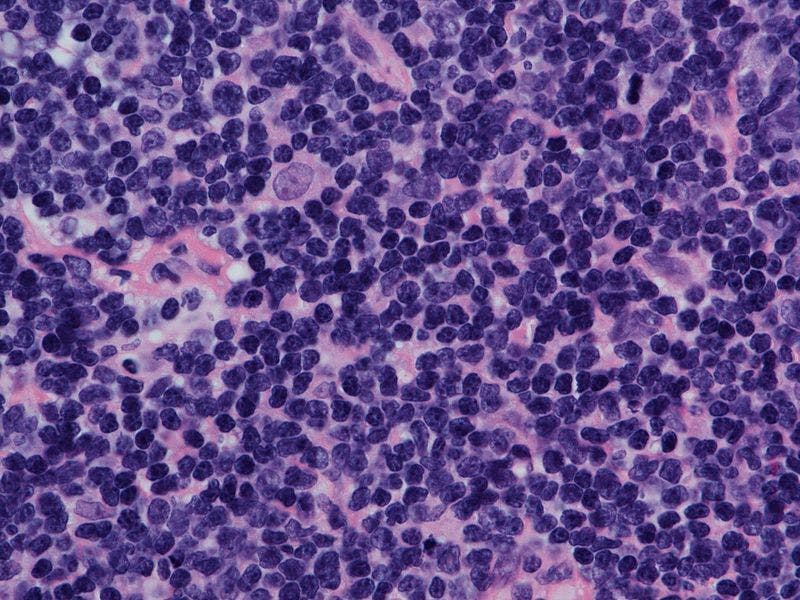 "The association of short [disease to treatment interval] with inferior survival in our study is similar to what has been shown in the diffuse large B-cell lymphoma [DLBCL] literature," according to the study authors.