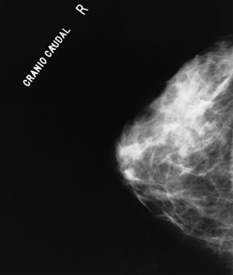 Breast Imaging Technique May Reduce Repeat Biopsies
