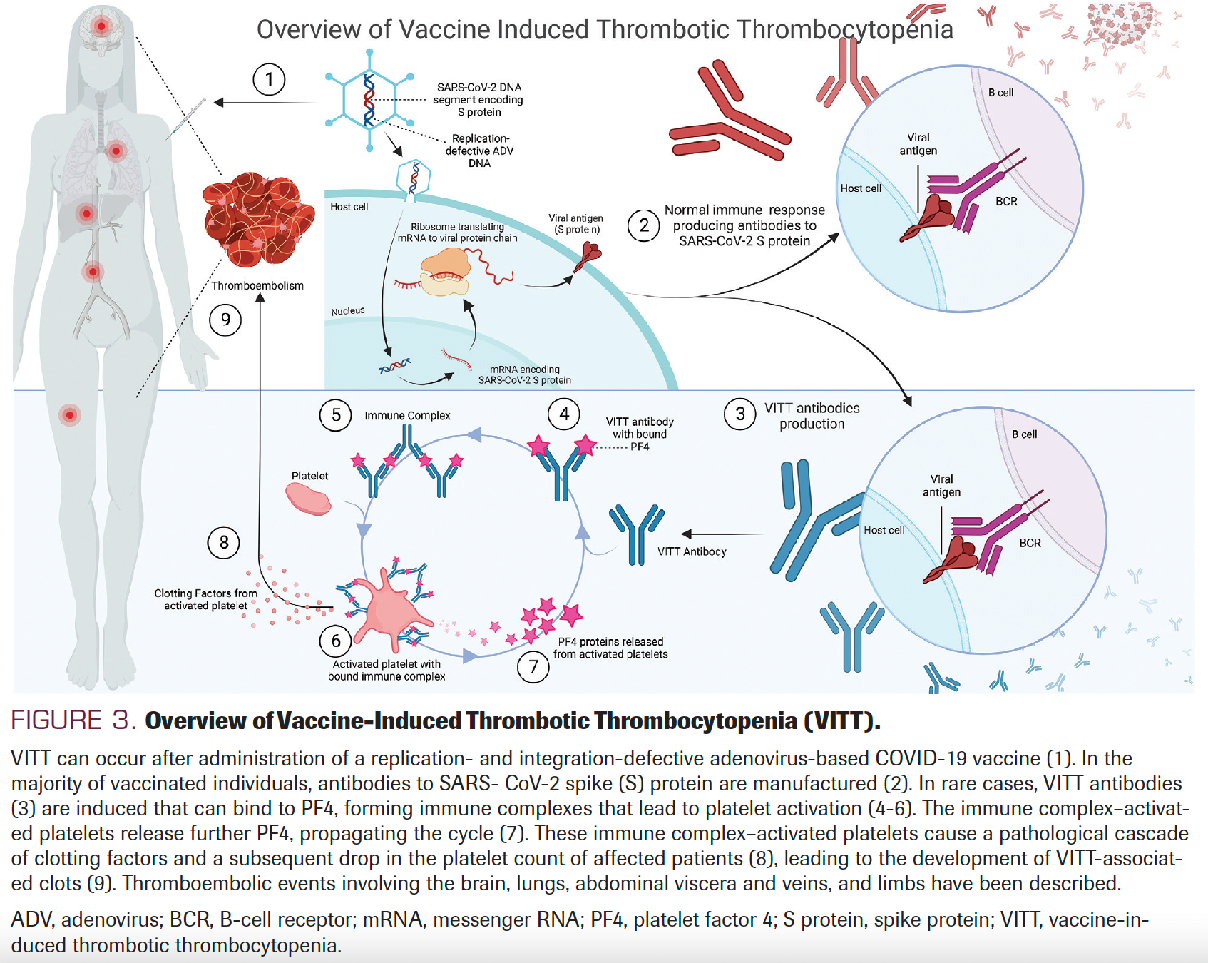 FIGURE 3. Overview of Vaccine-Induced Thrombotic Thrombocytopenia (VITT)