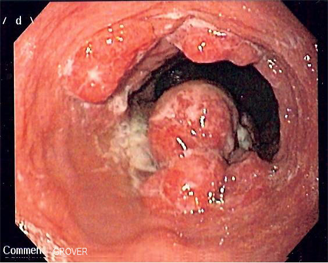 Endoscopic image of esophageal adenocarcinoma seen at gastroesophag