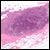 Phase III Randomized Breast Cancer Lymph Node Study Likely to be Practice-Changing