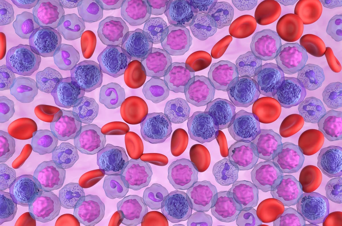 "LDH is a potent biochemical marker associated with lower response rates and poor survival in [patients with] AML," according to the study authors.
