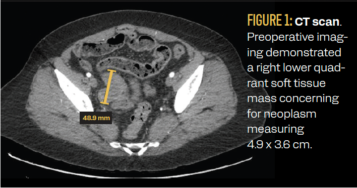 Synchronous Well-Differentiated Papillary Mesothelioma and Endometrioid Adenocarcinoma Arising From Endometriosis