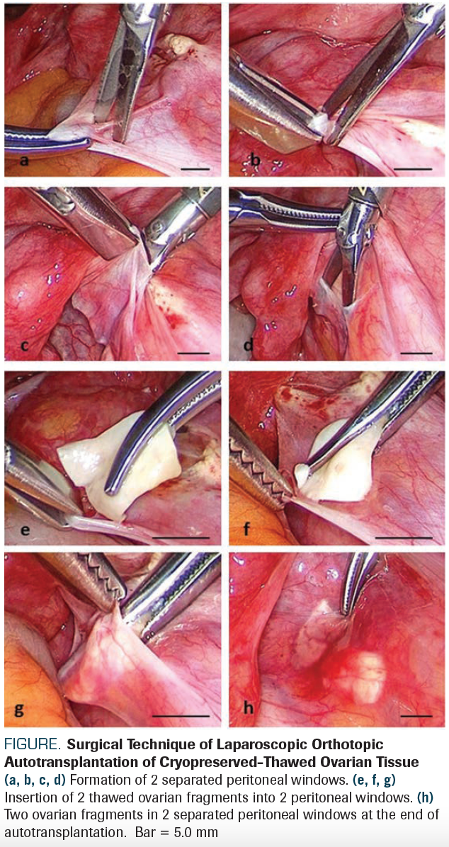 FIGURE. Surgical Technique of Laparoscopic Orthotopic Autotransplantation of Cryopreserved-Thawed Ovarian Tissue