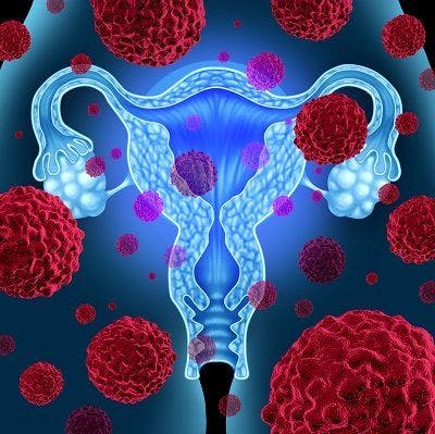PFS Not Established as a Surrogate End Point for OS in Treatment of Ovarian Cancer