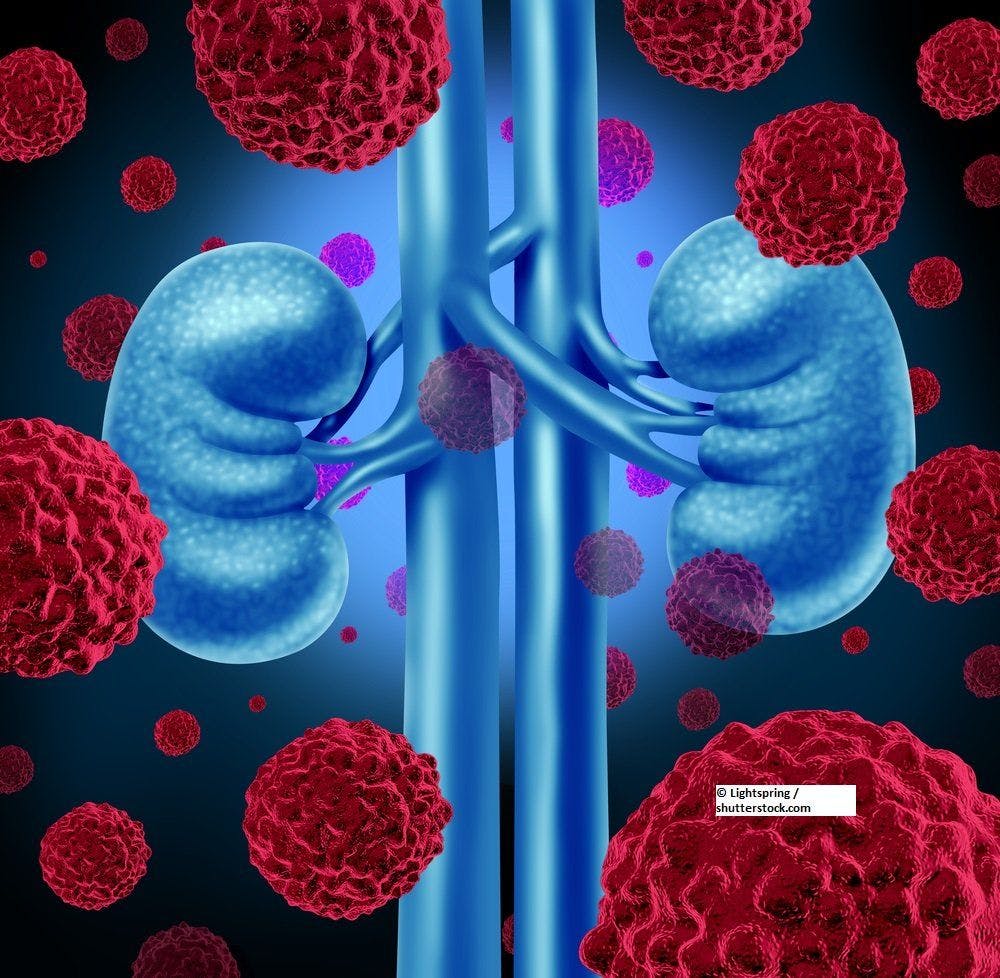 Renal Function Change Found to be a Prognostic Factor for Cancer Specific Survival in RCC