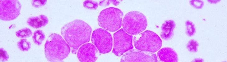 Patients With Acute Leukemias Have Increased Risk for Heart Failure, Study Shows