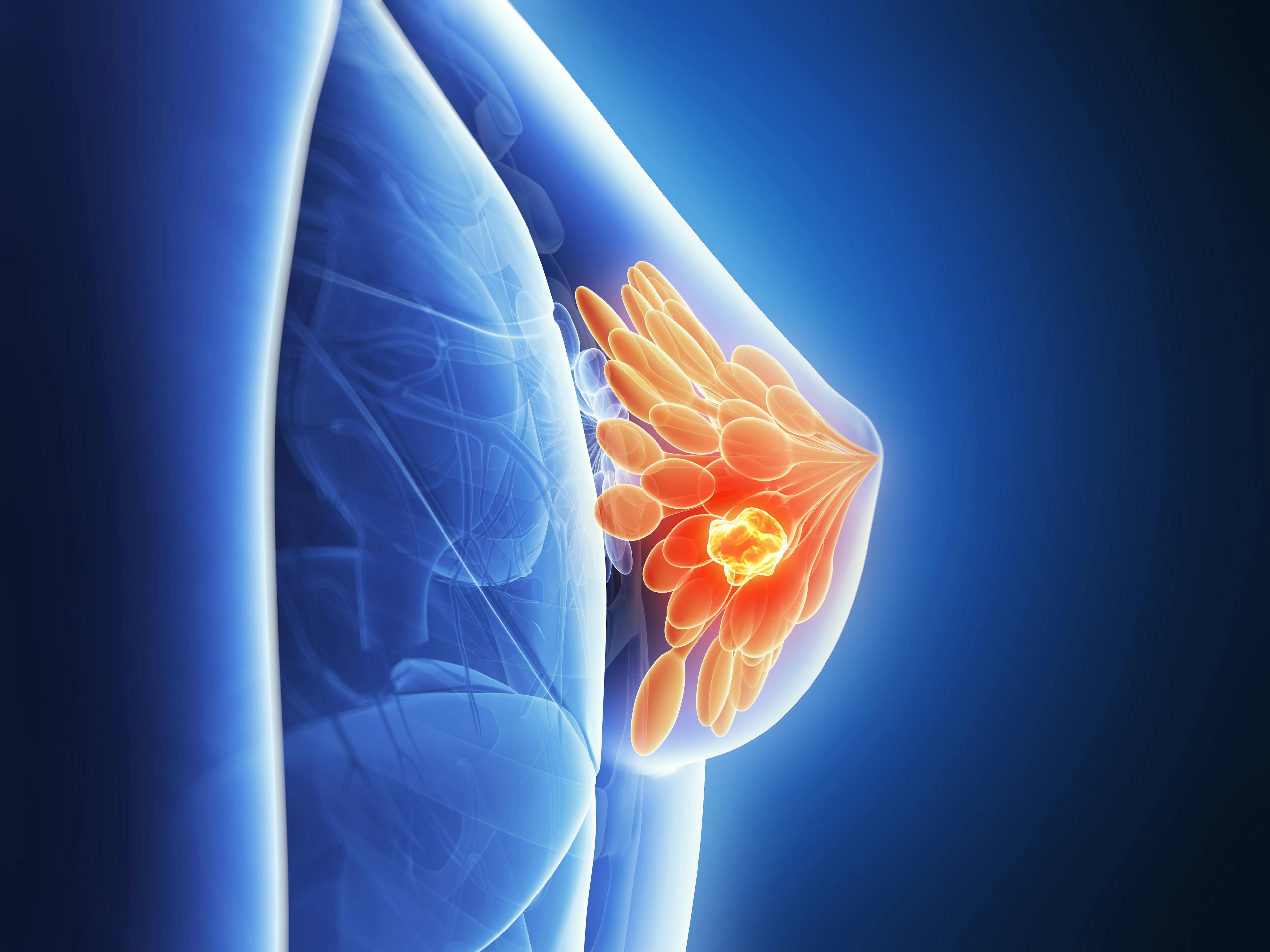 Combination everolimus/letrozole yielded a higher progression-free survival over letrozole alone in a population of patients with hormone receptor (HR)–positive, ERBB2-negative advanced breast cancer.