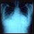 Risk of Congestive Heart Failure in Metastatic Breast Cancer Patients taking Bevacizumab