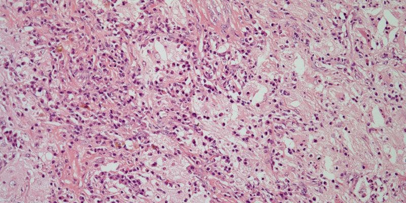 Intrapulmonary Mass Found in 54-Year-Old Patient