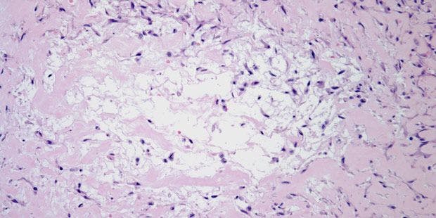 Soft-Tissue Lesion Found in 39-Year-Old Patient