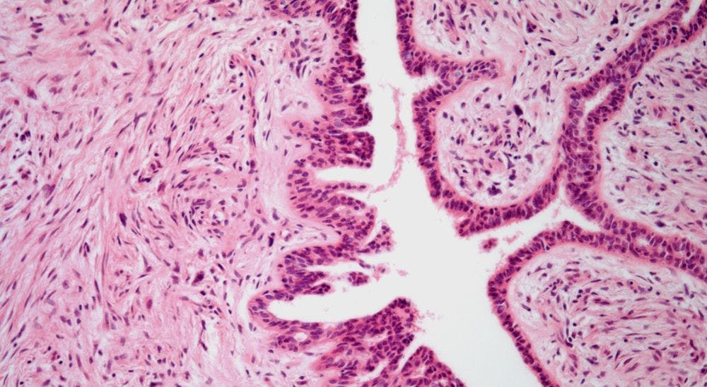 Breast Mass Discovered in 38-Year-Old Patient 