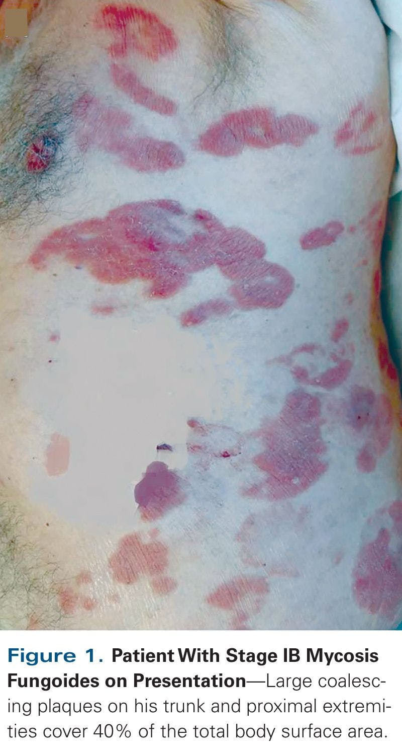 An Elderly Man With New Skin Plaques Consistent With Cutaneous T-Cell Lymphoma