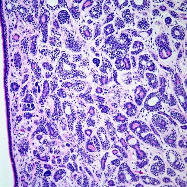 Bronchial Tumor Found in 53-Year-Old Patient