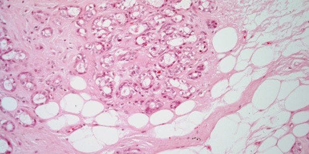 Breast Induration in 42-Year-Old Patient