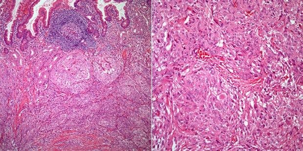 A 48-Year-Old Woman With Abdominal Pain; Mass in the Duodenum Is Discovered