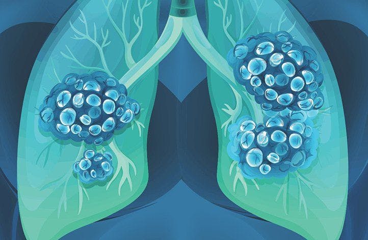 Celecoxib Added to Concurrent Chemoradiation Not Effective for Patients with NSCLC