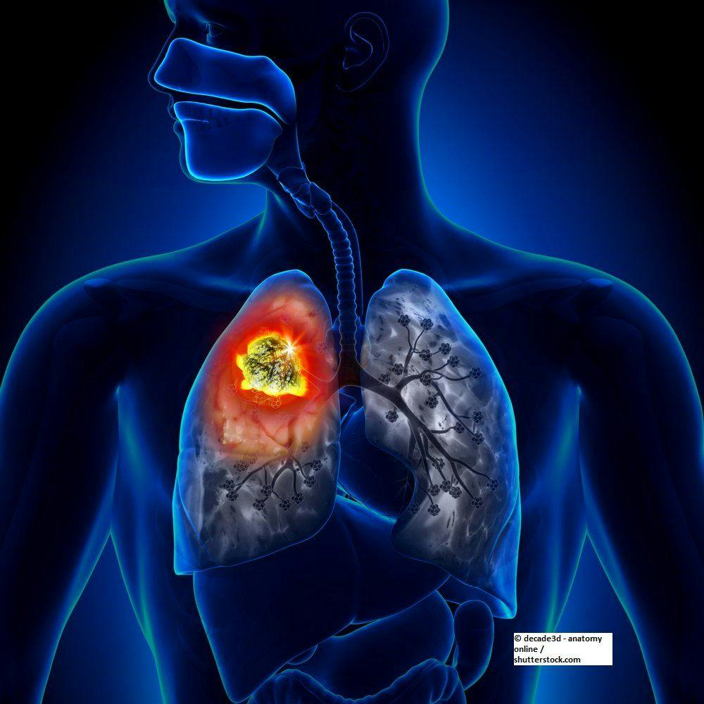 Does Adding Metformin to Chemoradiotherapy Improve NSCLC Survival?