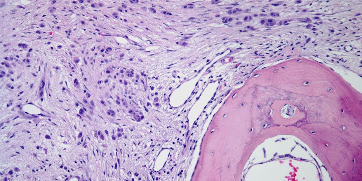 Patient Presents With Skin Mass on Shoulder