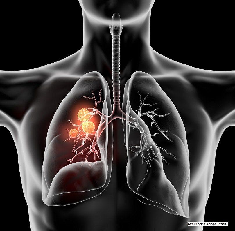 Chemo Regimen Boosts Gefitinib in EGFR-Mutant Lung Cancer, But at What Cost?