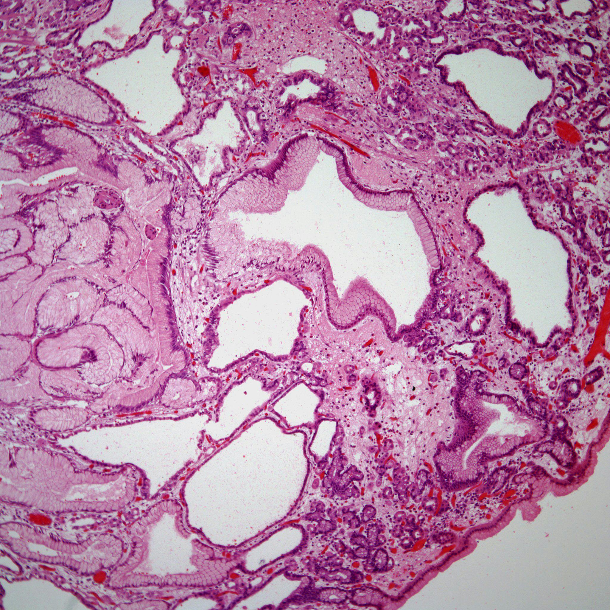 A 40-Year-Old With a Stomach Nodule