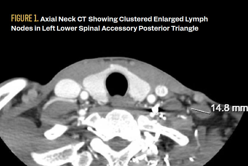 FIGURE 1. Axial Neck CT Showing Clustered Enlarged Lymph Nodes in Left Lower Spinal Accessory Posterior Triangle