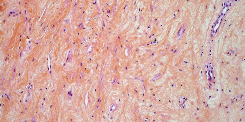 Peritoneal Mass Found in 31-Year-Old Patient