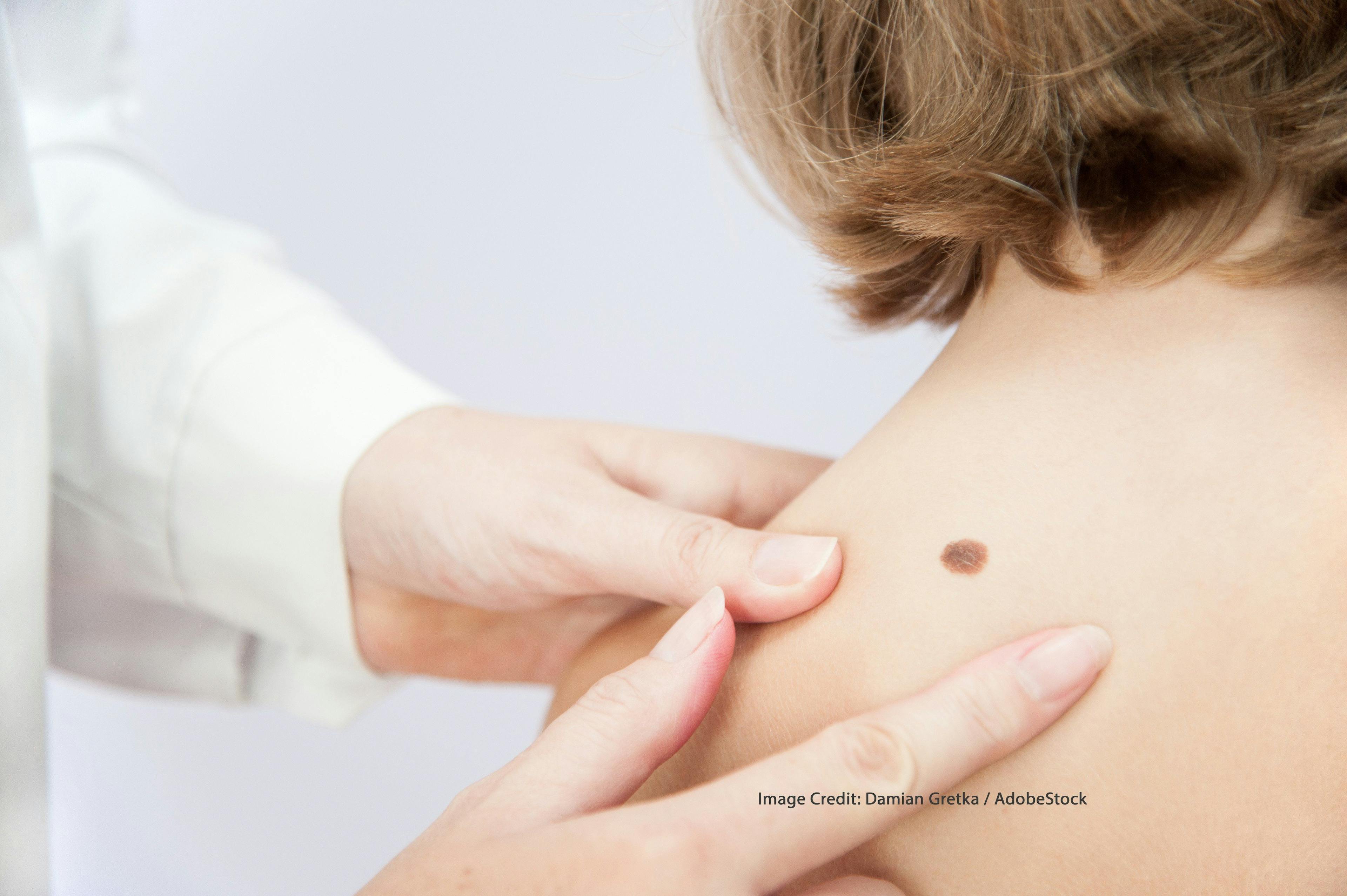 Potential Role of the HPV Vaccine in Preventing Non-Melanoma Skin Cancers