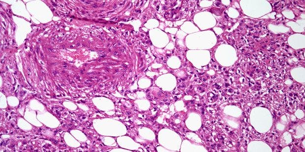 A 48-Year-Old Patient Presents With Kidney Mass