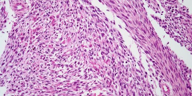 Mass Discovered in Arm of 35-Year-Old Man