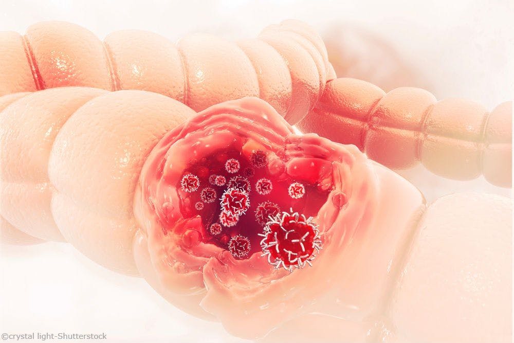 New Biomarker Recognized For Colorectal Cancers