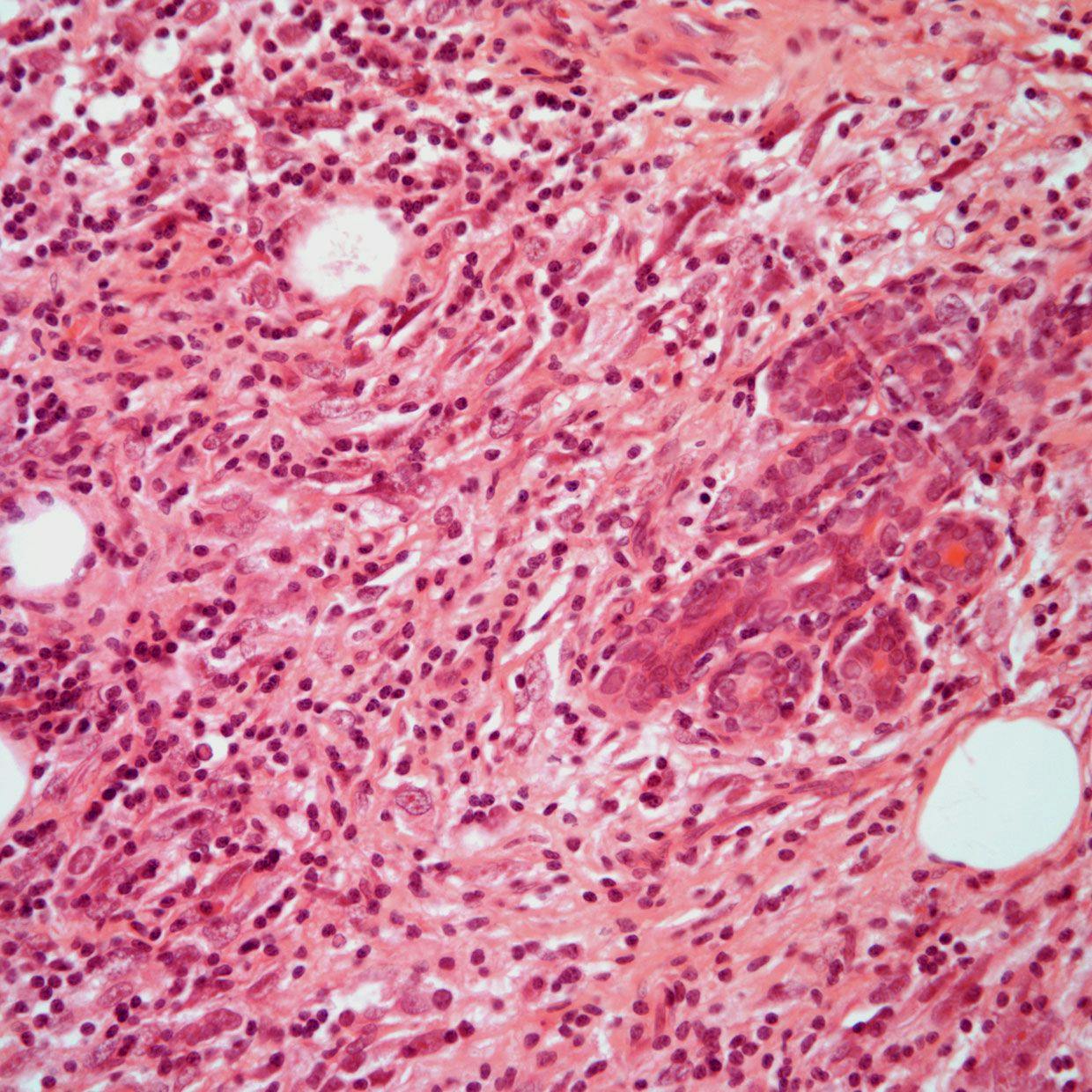 Small Nodule Found in Breast of 37-Year-Old Patient