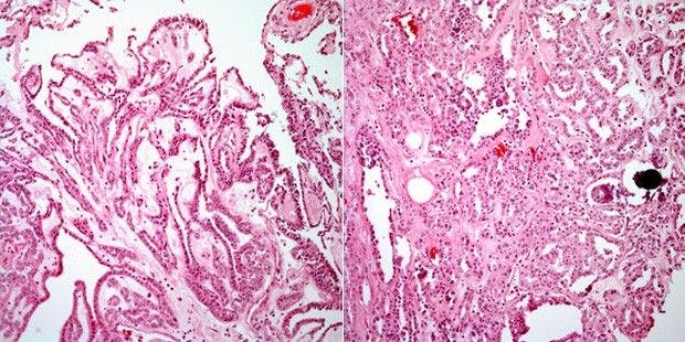 Large, Right Kidney Mass Discovered in 48-Year-Old Woman