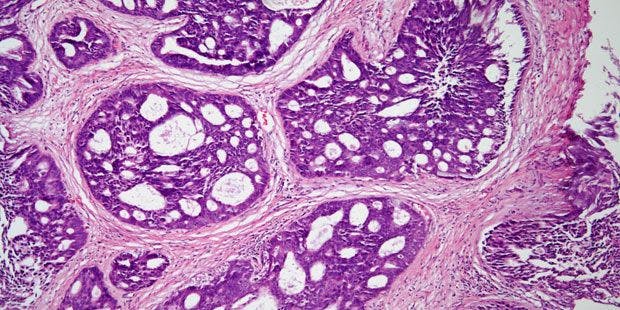 Prostate Biopsy From 62-Year-Old Patient
