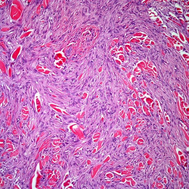 A 54-Year-Old Patient Presents With Back Nodule