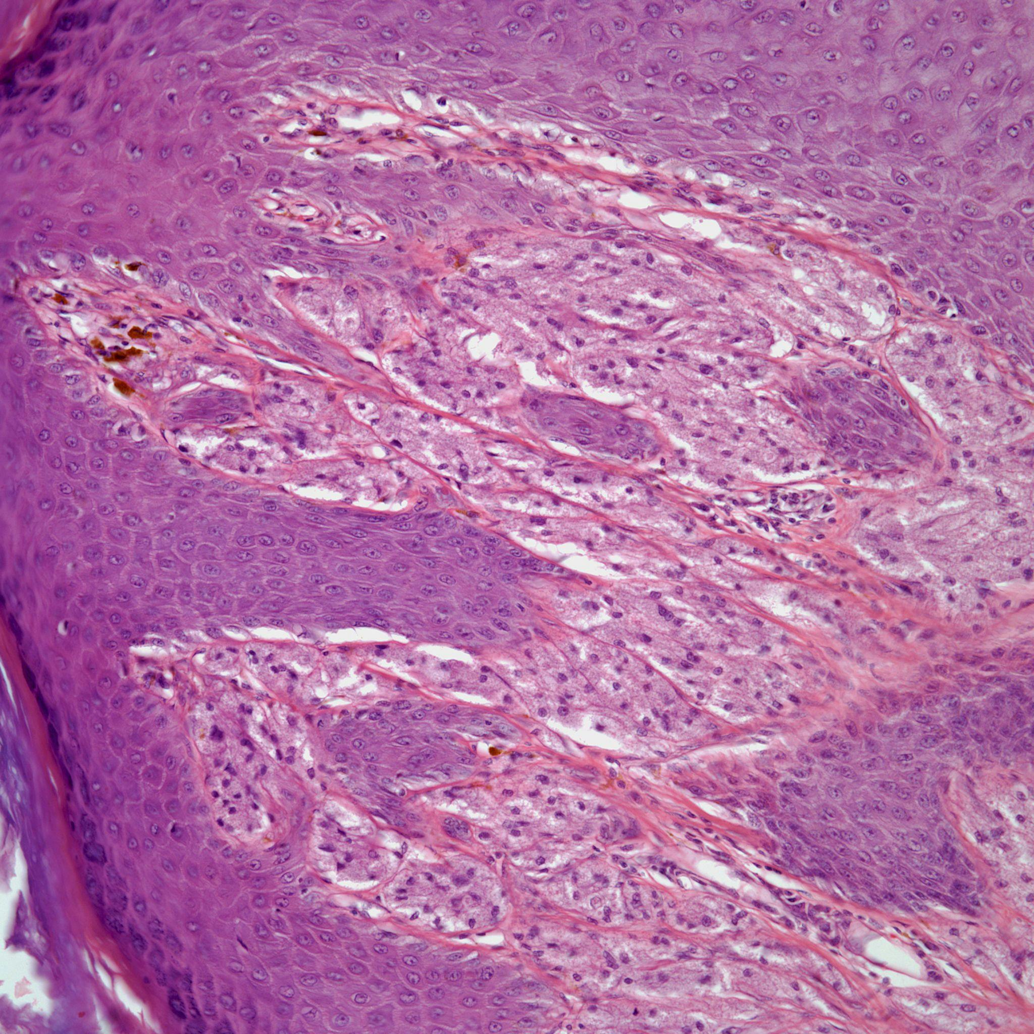 A 34-Year-Old Male With a Skin Tumor