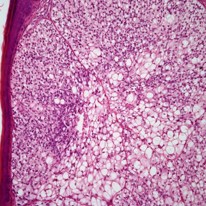 Skin Lesion Found on 54-Year-Old Patient