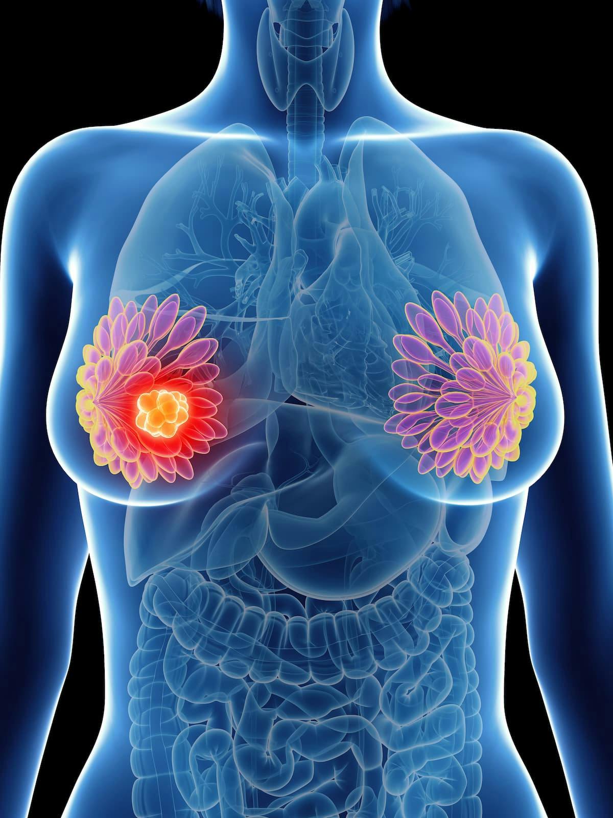 An increased TIL count in the breast tissue was associated with improved distant recurrence-free survival in patients with triple-negative breast cancer. 