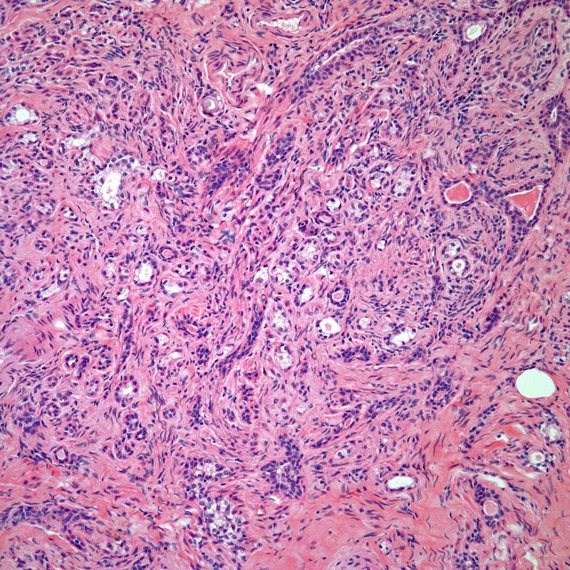 Breast Lesion in 40-Year-Old Patient