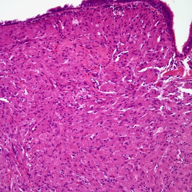 Bronchial Mass Found in 42-Year-Old Patient