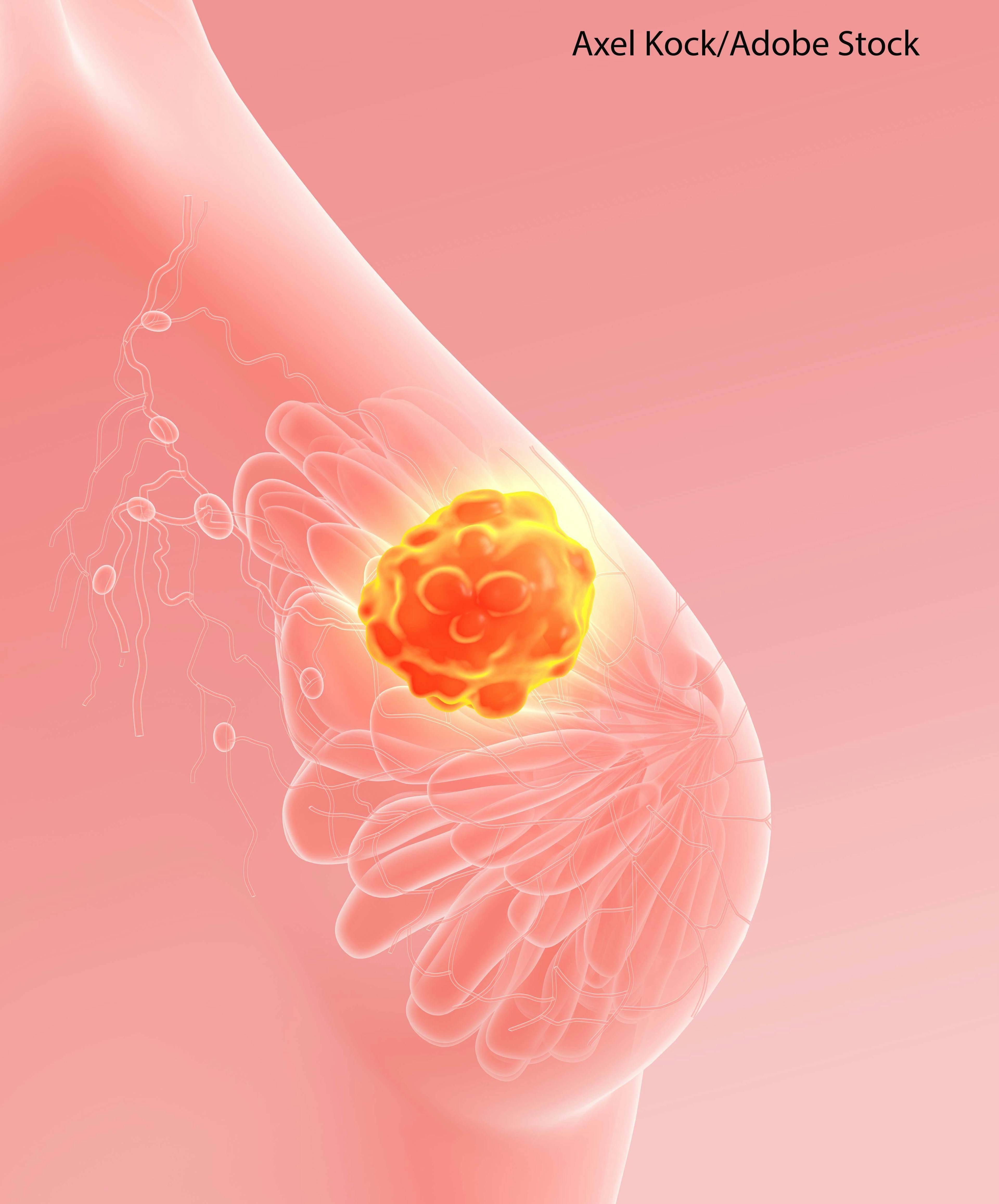 Data Reveals DNA Variations that Alter Breast Cancer Risk in Women