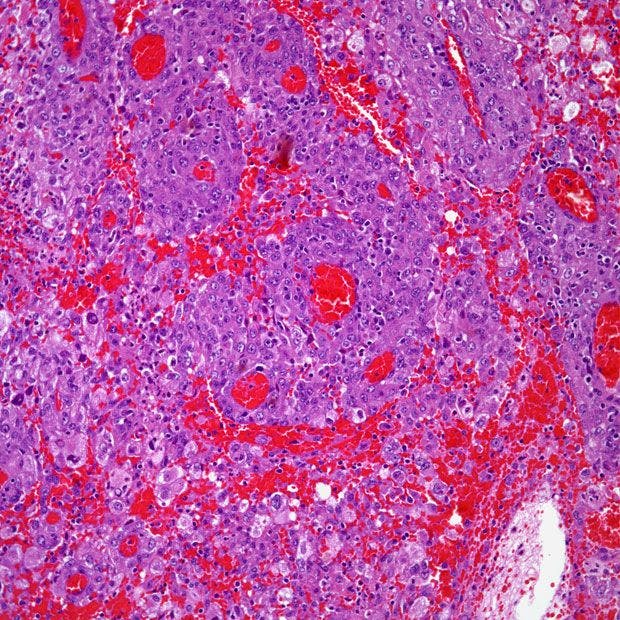 Lung Mass Found in 61-Year-Old Patient
