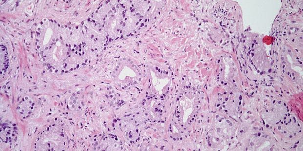Prostate Biopsy From 59-Year-Old Patient