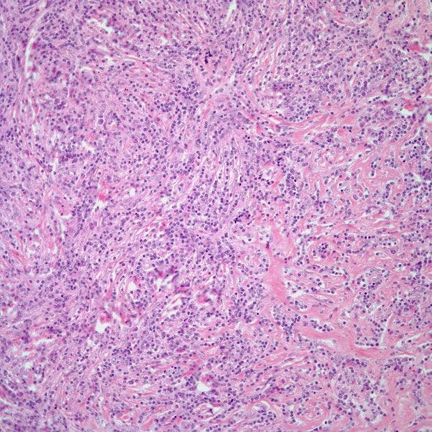 Patient Presents With Axillary Lymphadenopathy