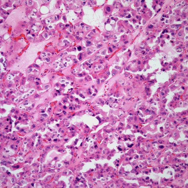 Kidney Mass Discovered in 54-Year-Old Patient
