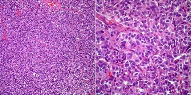 Bronchial Mass Discovered in 47-Year-Old Woman